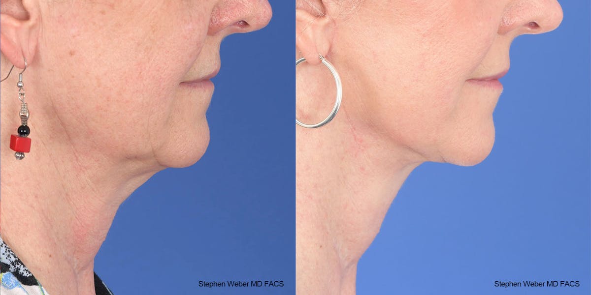 Facelift Before & After Gallery - Patient 208838 - Image 4