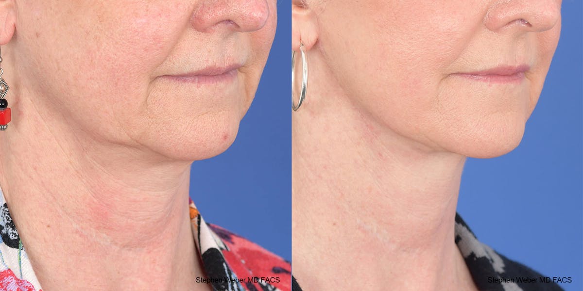 Facelift Before & After Gallery - Patient 208838 - Image 5