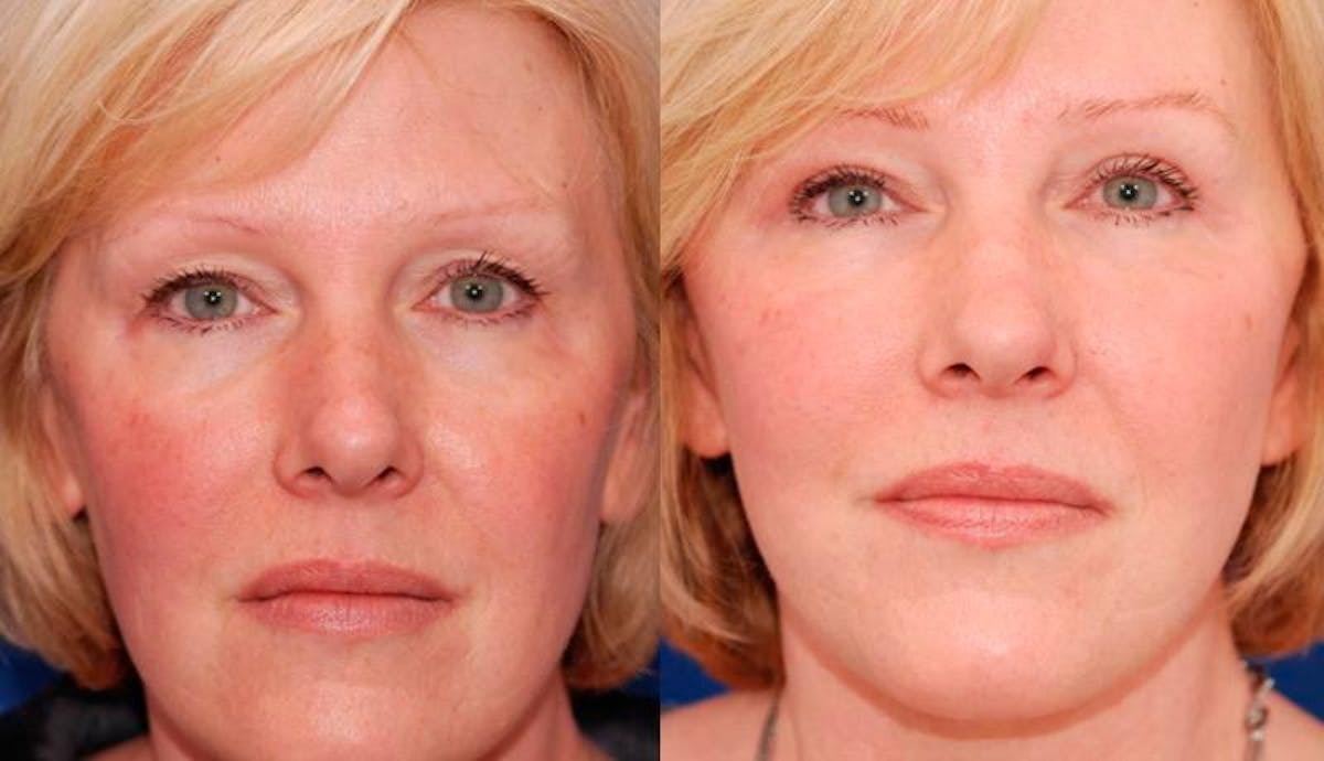Facelift Before & After Gallery - Patient 113755 - Image 1