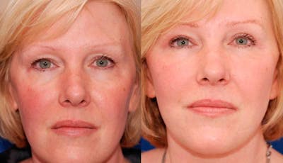 Facelift Before & After Gallery - Patient 113755 - Image 1