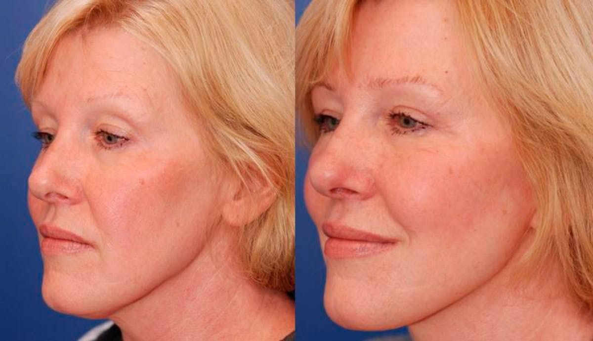 Facelift Before & After Gallery - Patient 113755 - Image 2