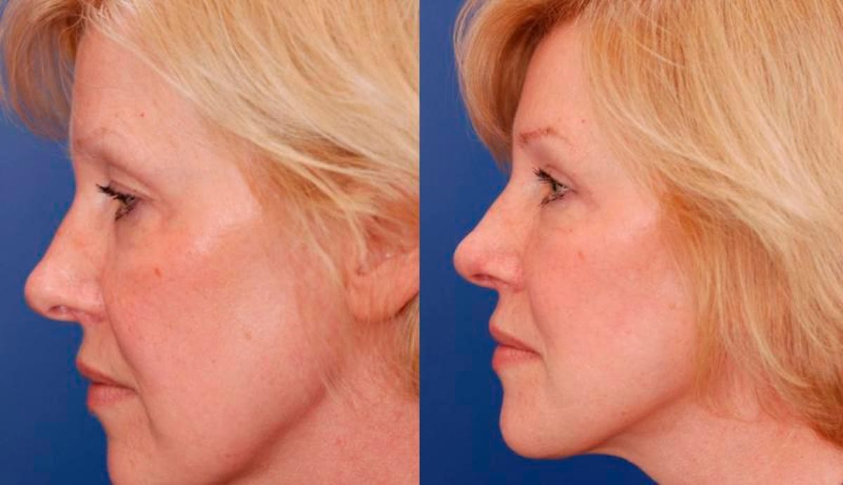 Facelift Before & After Gallery - Patient 113755 - Image 3