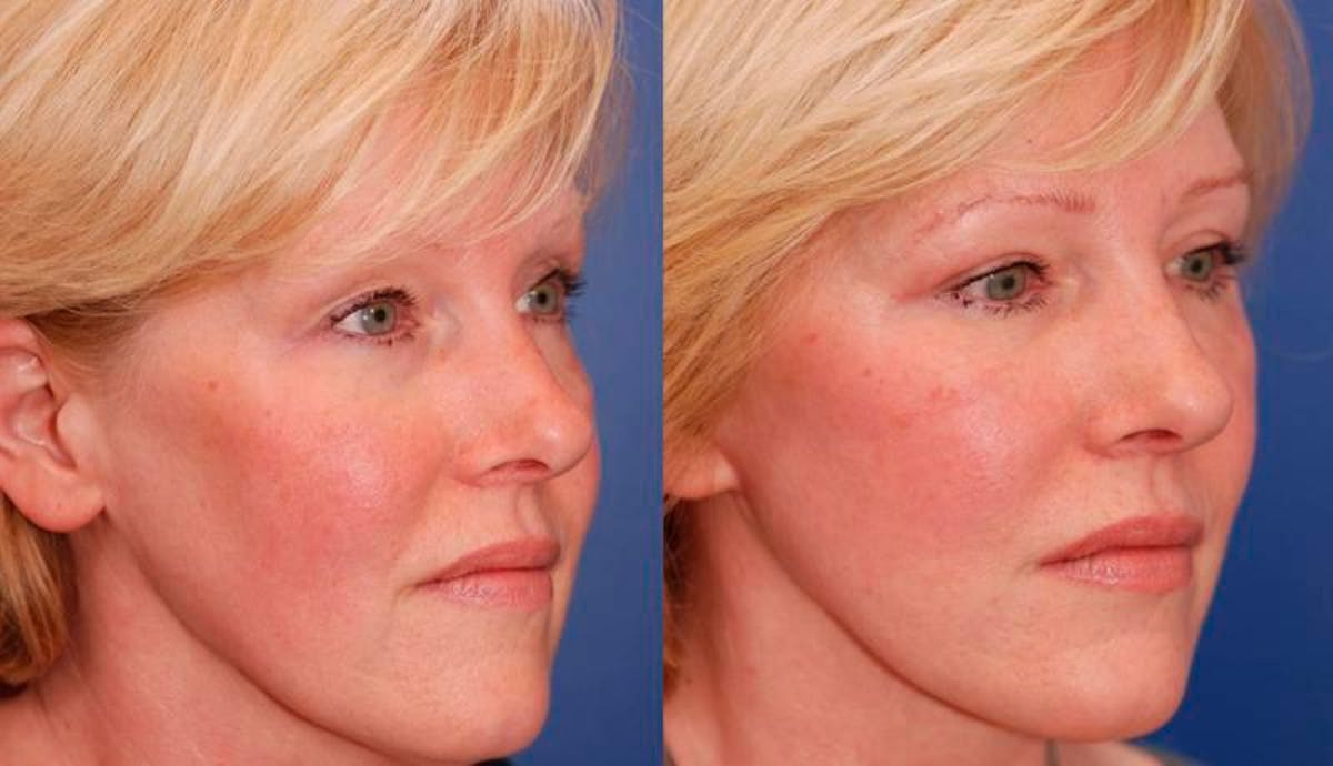 Facelift Before & After Gallery - Patient 113755 - Image 4