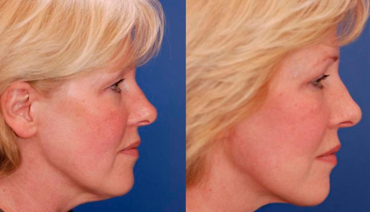 Facelift Before & After Gallery - Patient 113755 - Image 5