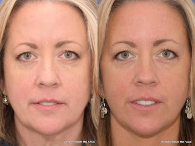 Facelift Before & After Gallery - Patient 304179 - Image 1
