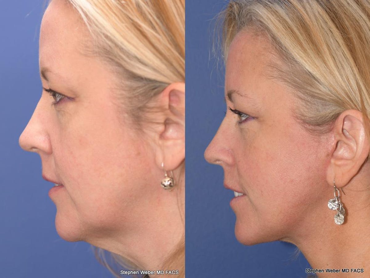 Facelift Before & After Gallery - Patient 304179 - Image 2