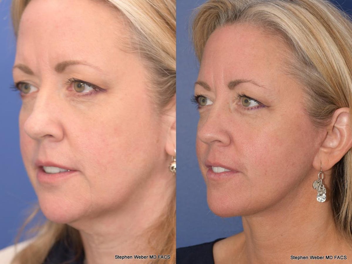 Facelift Before & After Gallery - Patient 304179 - Image 3