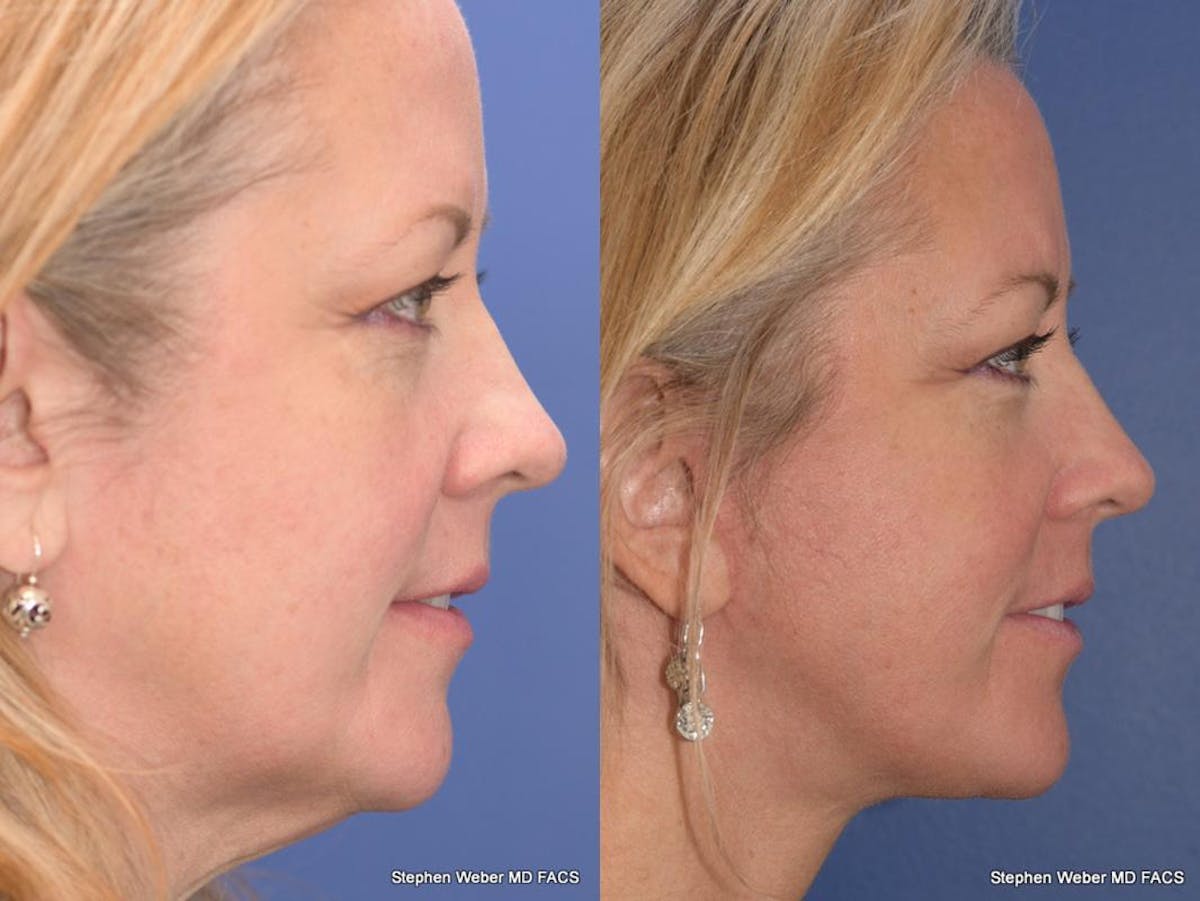 Facelift Before & After Gallery - Patient 304179 - Image 4