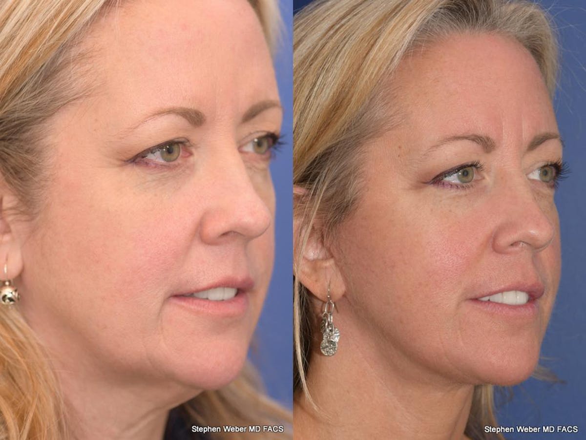 Facelift Before & After Gallery - Patient 304179 - Image 5