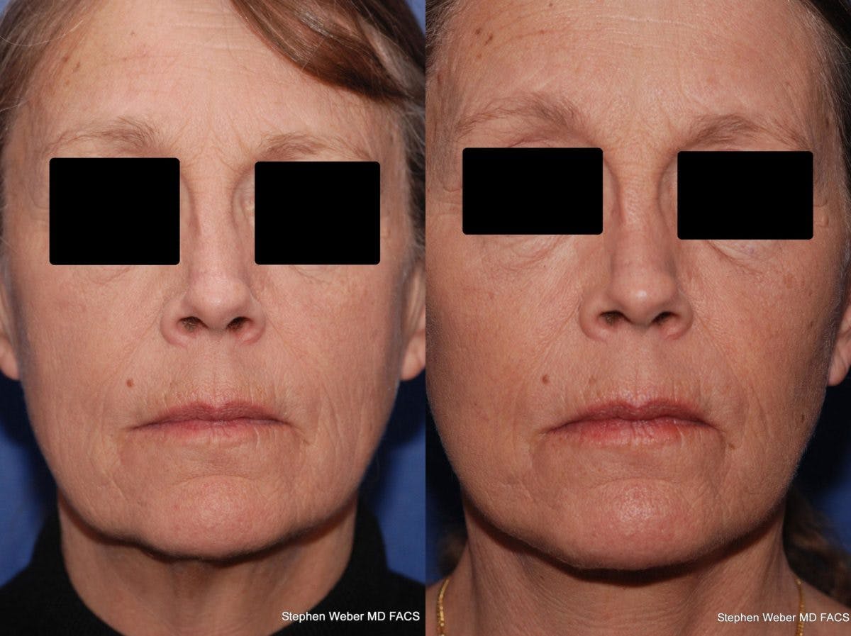 Facelift Before & After Gallery - Patient 196264 - Image 1