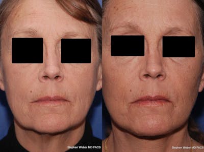 Facelift Before & After Gallery - Patient 196264 - Image 1