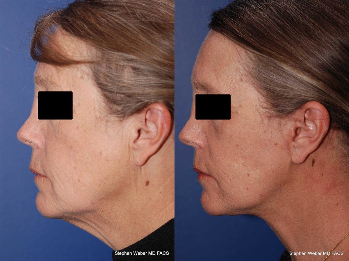 Facelift Before & After Gallery - Patient 196264 - Image 2