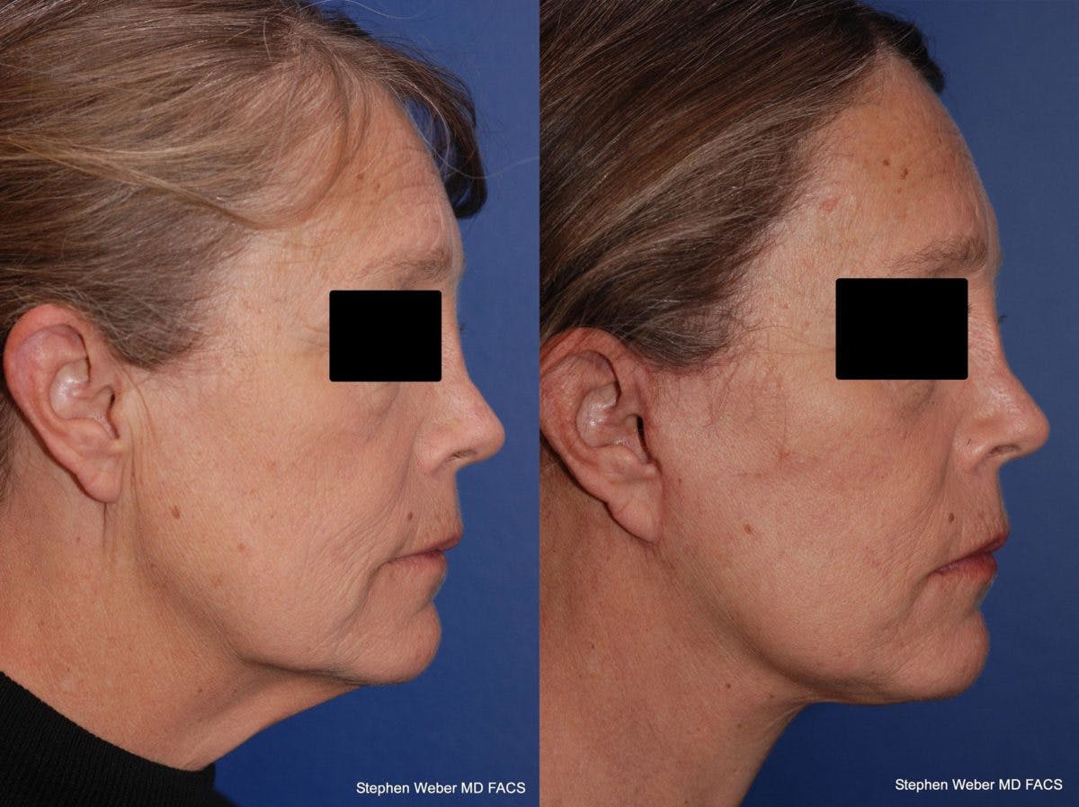 Facelift Before & After Gallery - Patient 196264 - Image 3