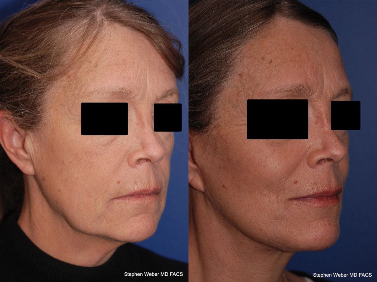 Facelift Before & After Gallery - Patient 196264 - Image 5
