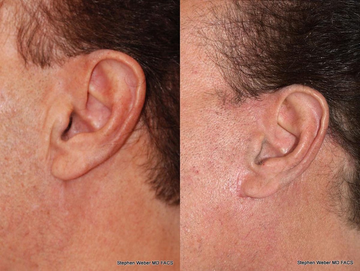 Facelift Before & After Gallery - Patient 386596 - Image 1