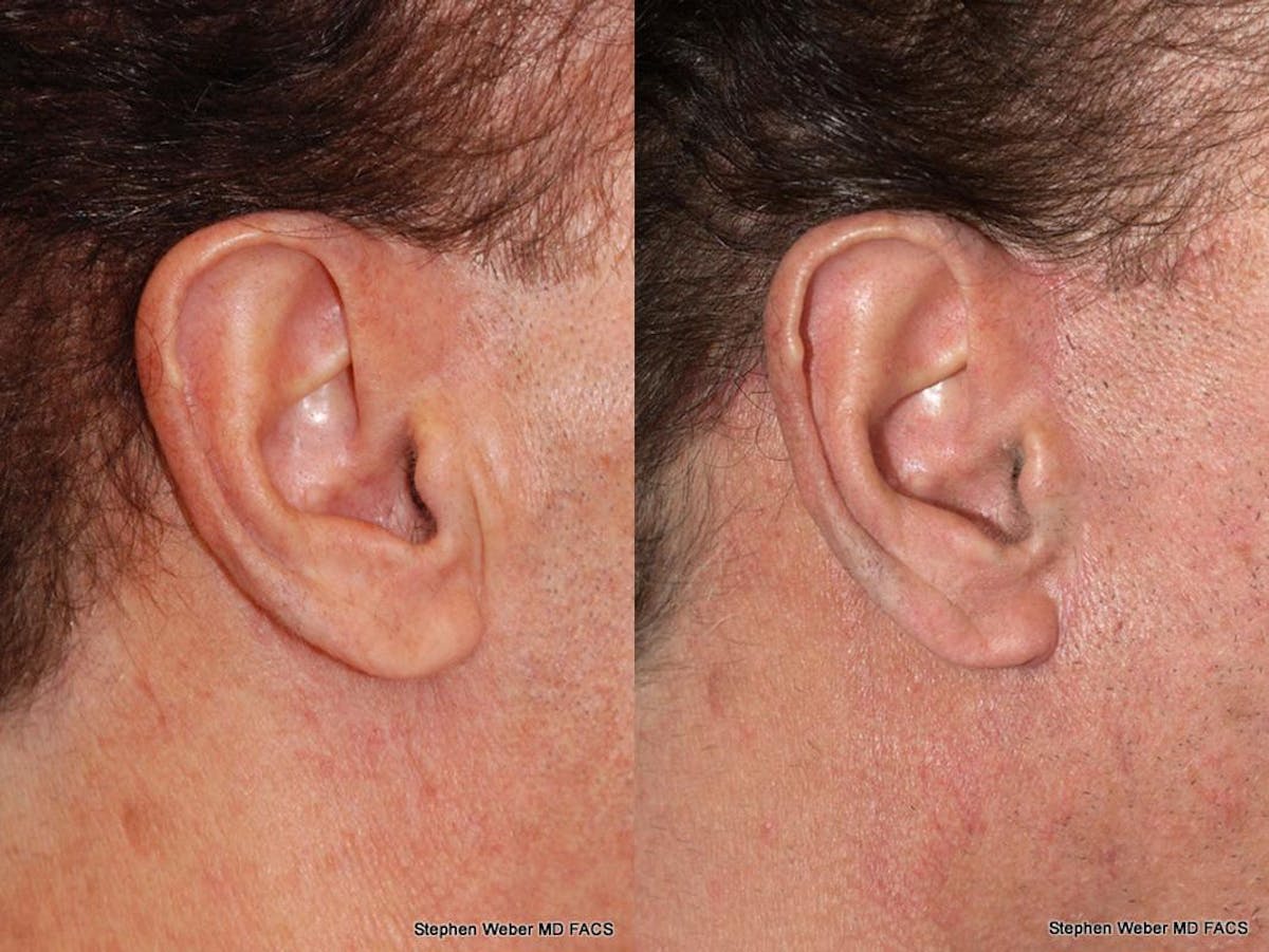 Facelift Before & After Gallery - Patient 386596 - Image 2