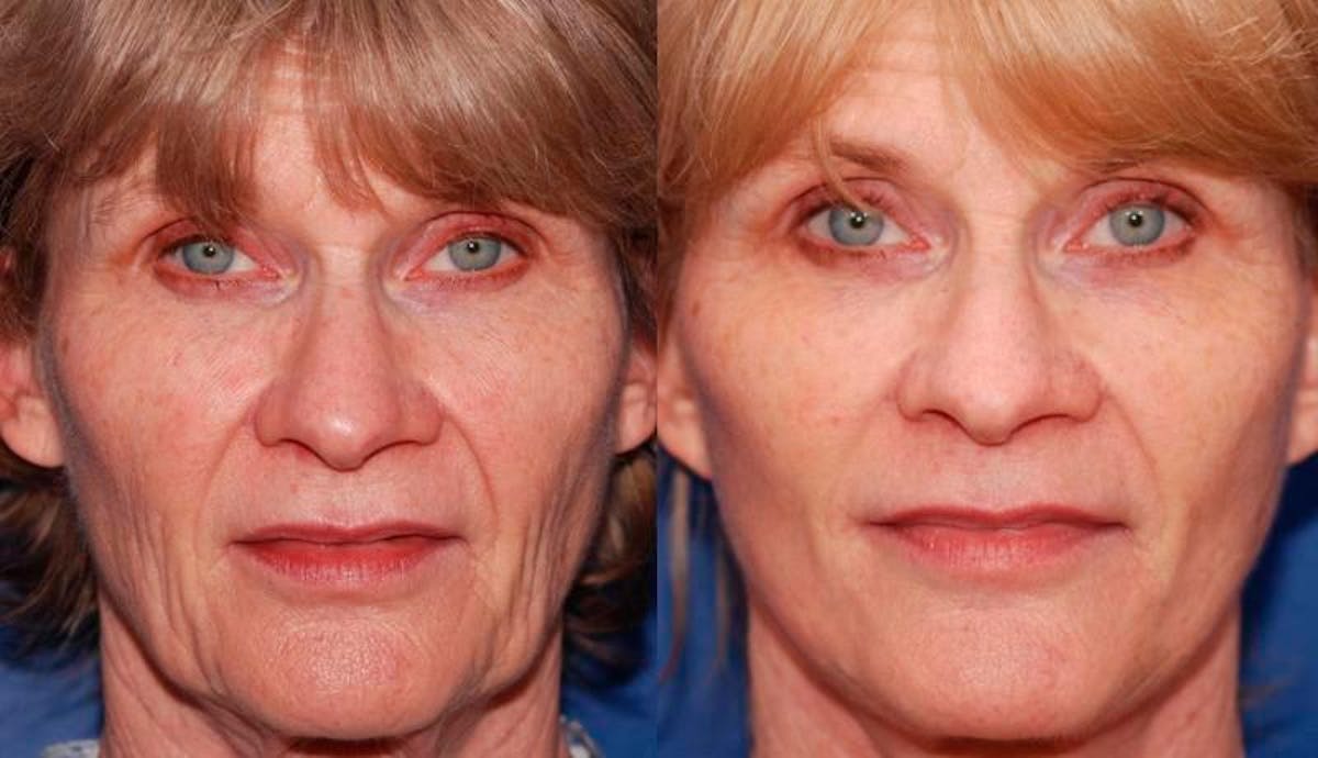 Facelift Before & After Gallery - Patient 486629 - Image 1