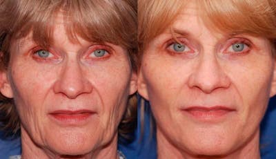 Facelift Before & After Gallery - Patient 486629 - Image 1