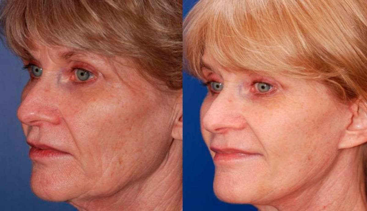 Facelift Before & After Gallery - Patient 486629 - Image 2
