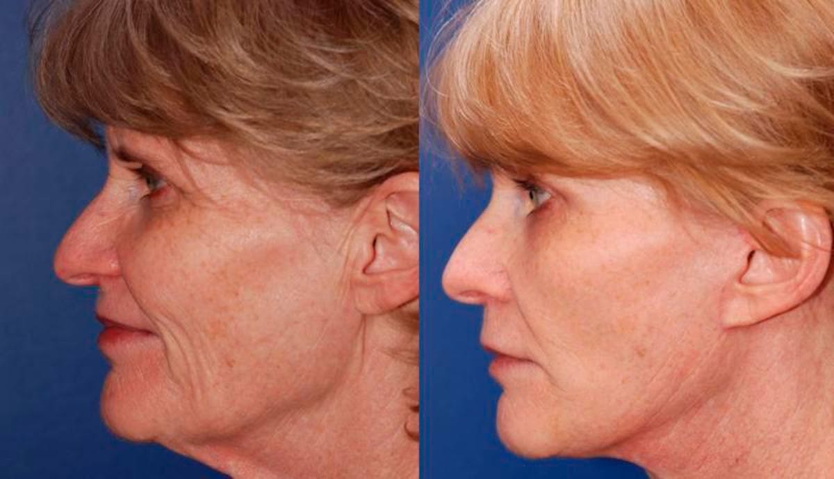 Facelift Before & After Gallery - Patient 486629 - Image 3