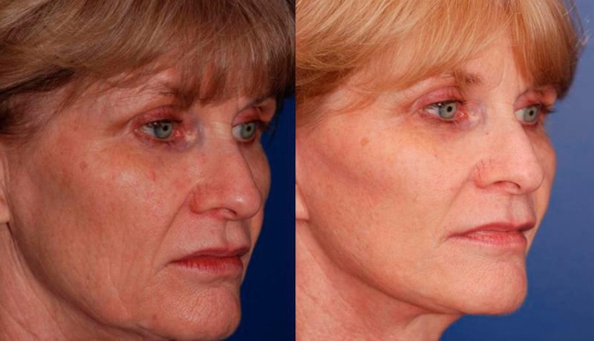 Facelift Before & After Gallery - Patient 486629 - Image 4