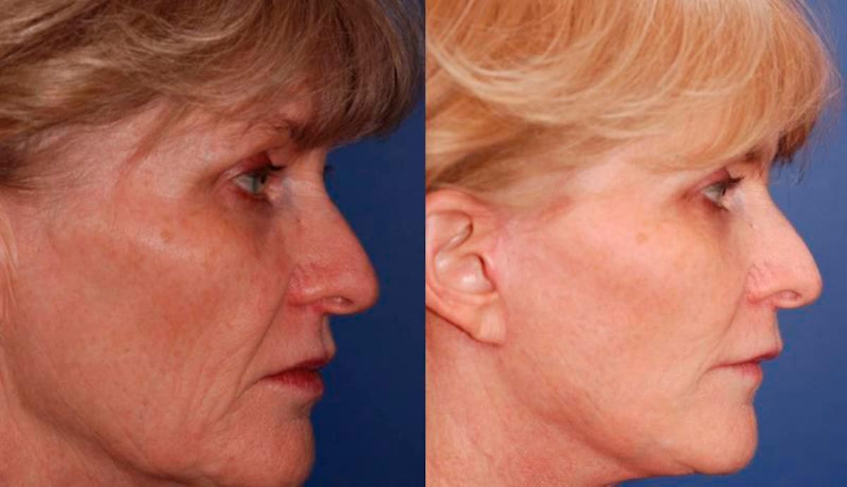 Facelift Before & After Gallery - Patient 486629 - Image 5