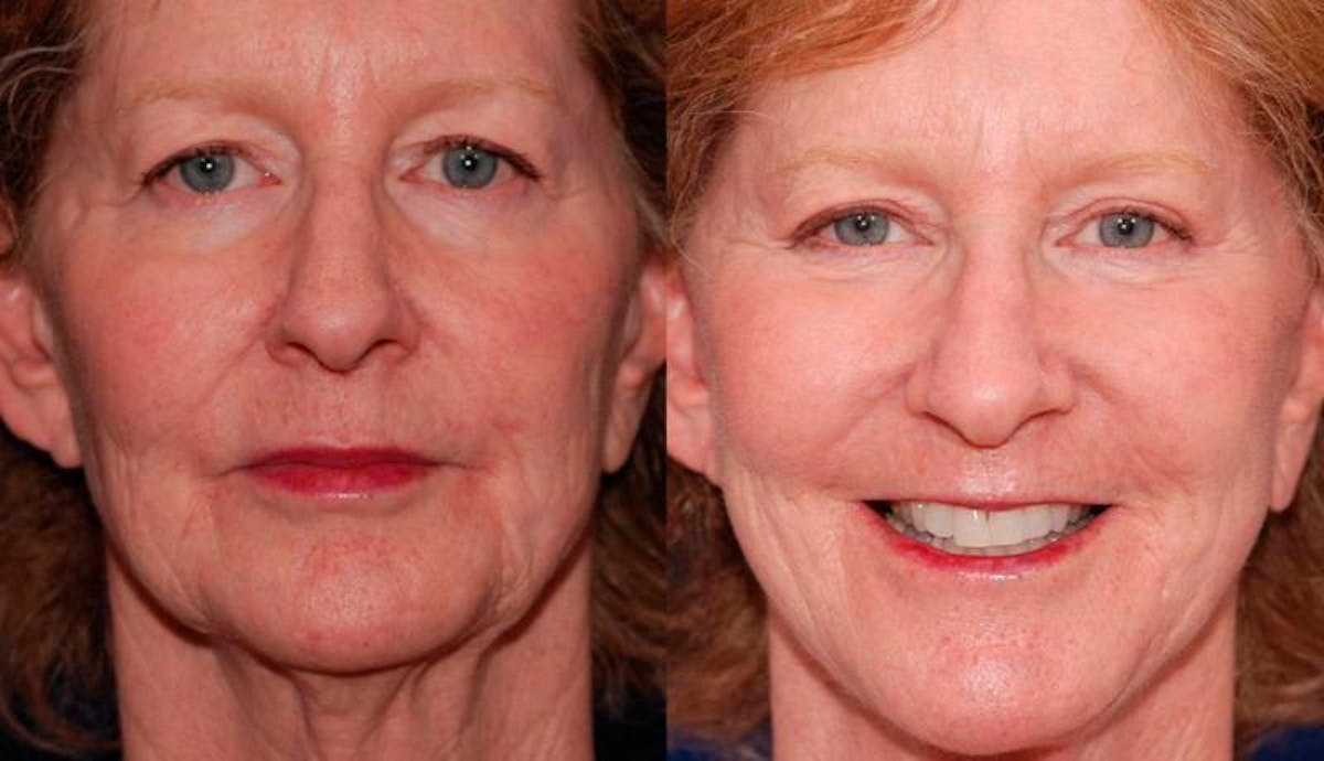 Facelift Before & After Gallery - Patient 135785 - Image 1