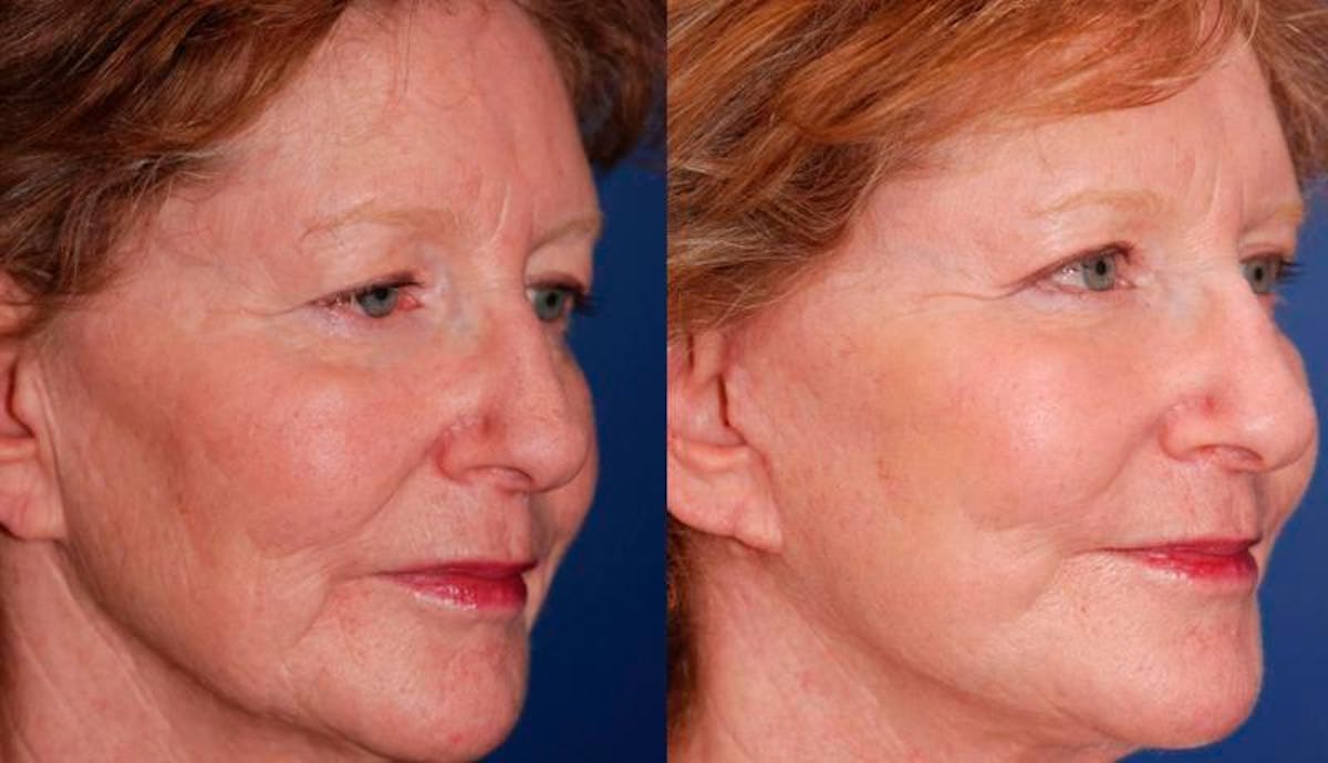 Facelift Before & After Gallery - Patient 135785 - Image 2
