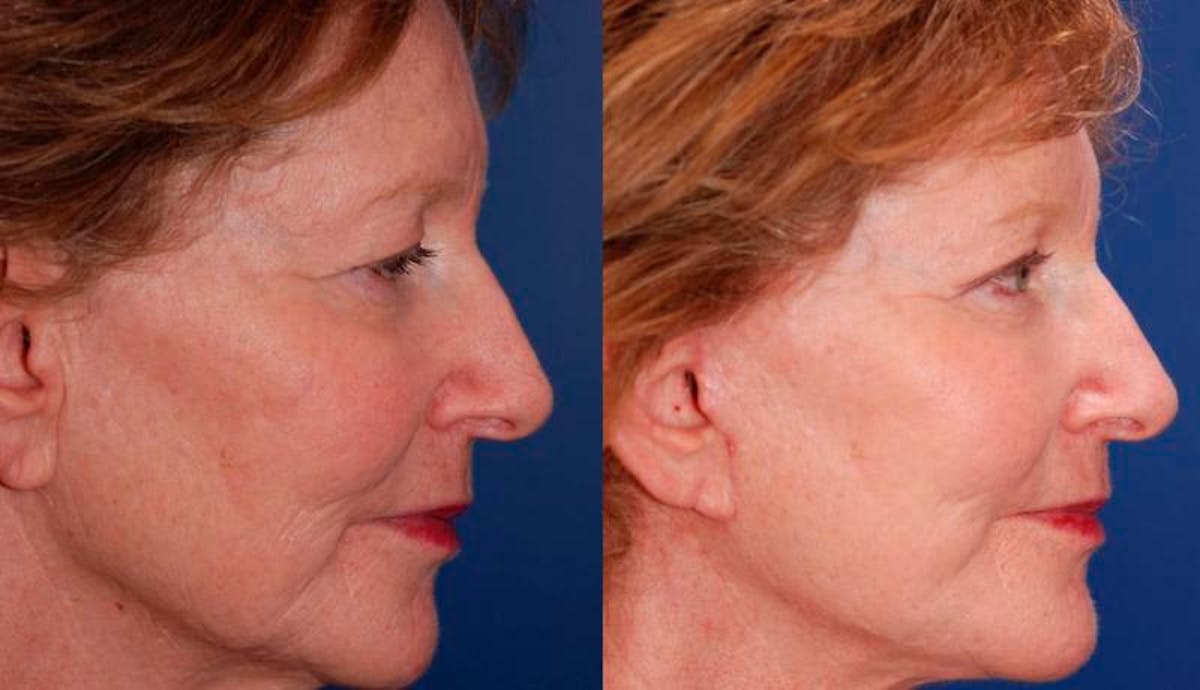 Facelift Before & After Gallery - Patient 135785 - Image 3