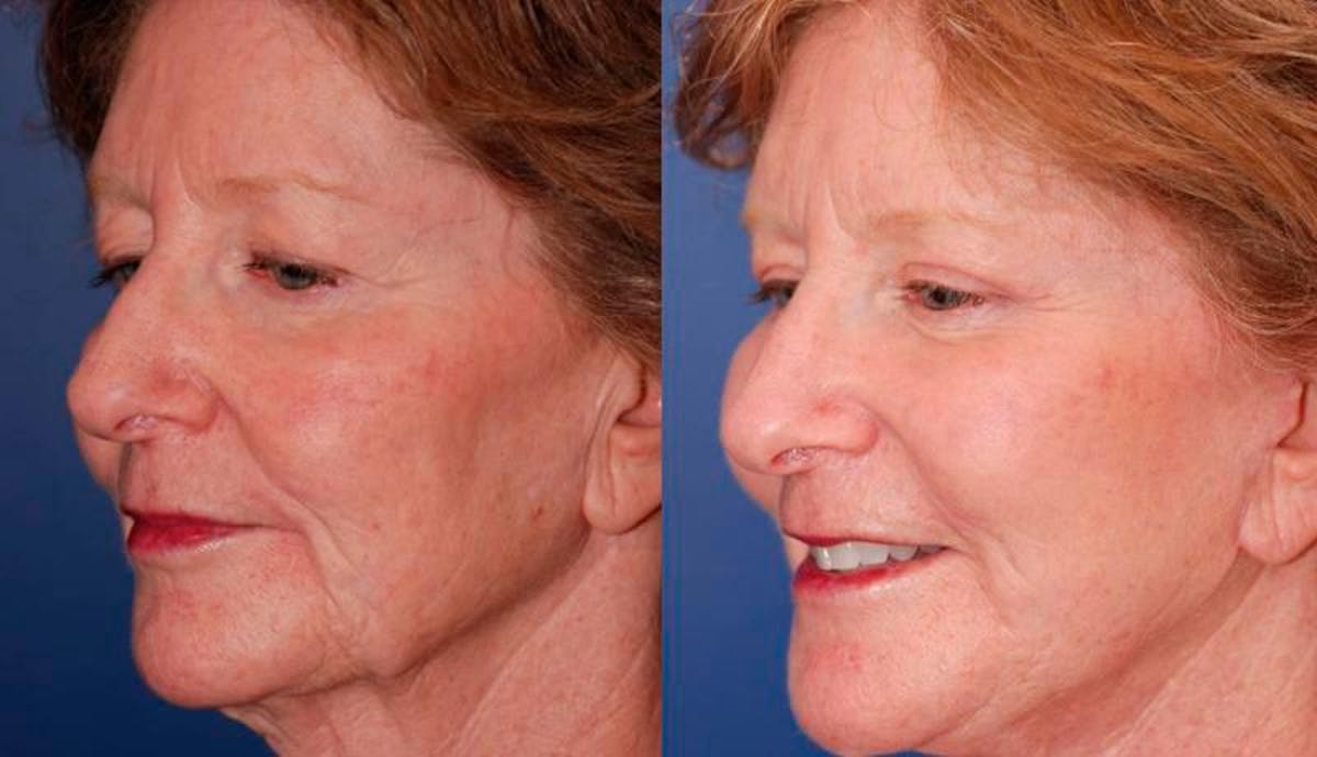 Facelift Before & After Gallery - Patient 135785 - Image 4