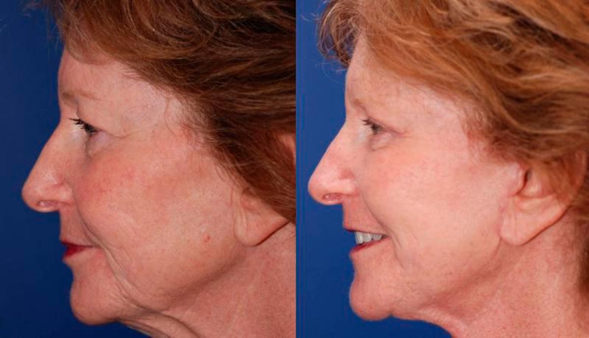 Facelift Before & After Gallery - Patient 135785 - Image 5
