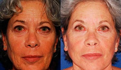 Facelift Before & After Gallery - Patient 117042 - Image 1