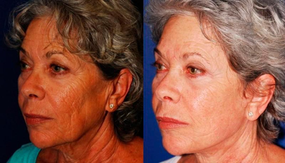 Facelift Before & After Gallery - Patient 117042 - Image 2
