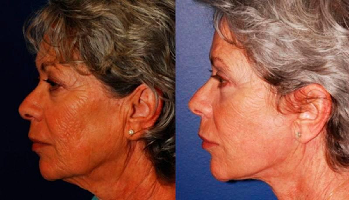 Facelift Before & After Gallery - Patient 117042 - Image 3