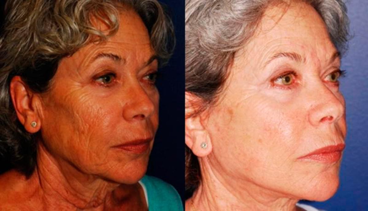 Facelift Before & After Gallery - Patient 117042 - Image 4