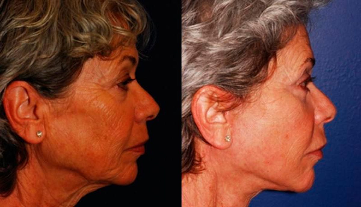 Facelift Before & After Gallery - Patient 117042 - Image 5