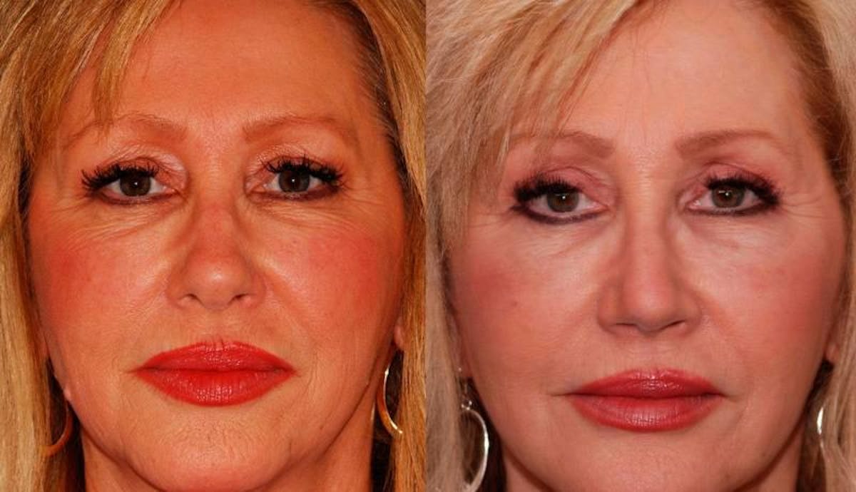 Facelift Before & After Gallery - Patient 406061 - Image 1