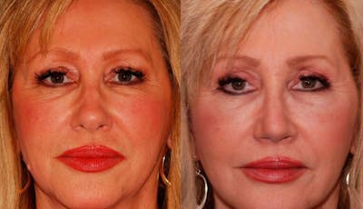 Facelift Before & After Gallery - Patient 406061 - Image 1