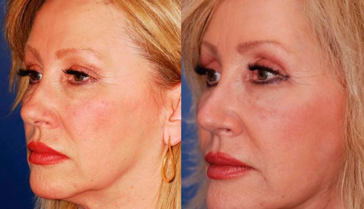 Facelift Before & After Gallery - Patient 406061 - Image 2
