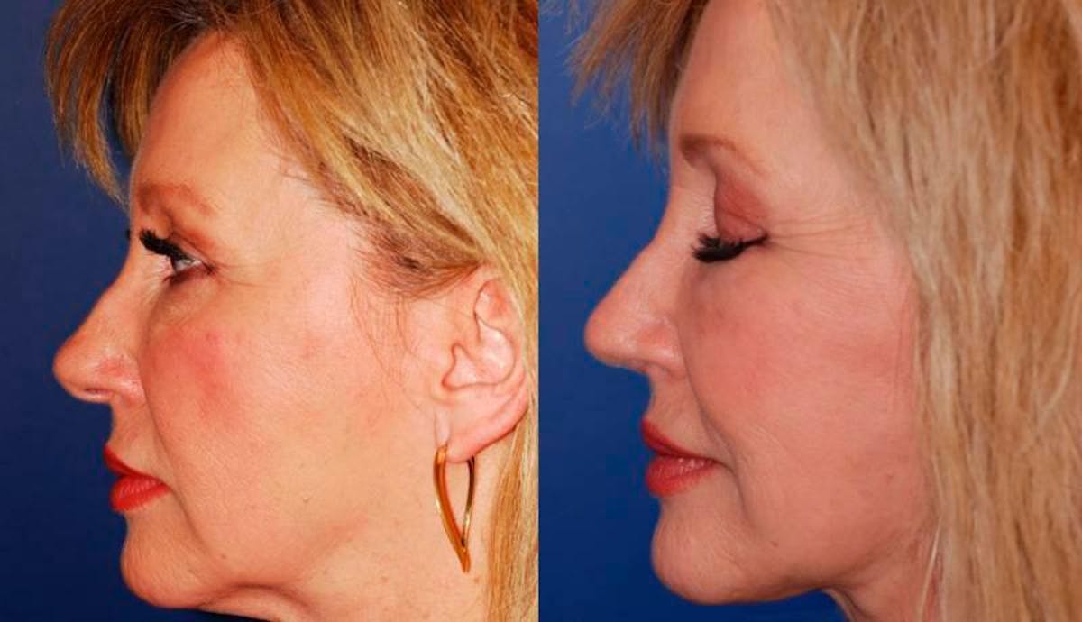 Facelift Before & After Gallery - Patient 406061 - Image 3