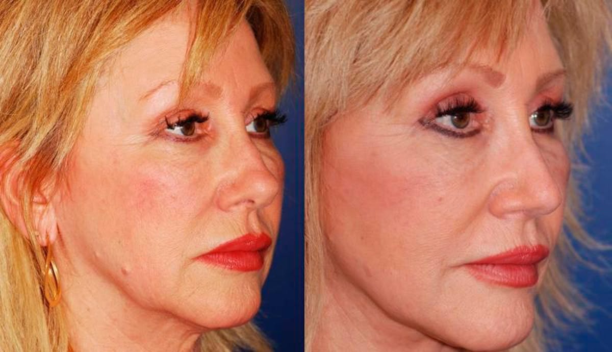 Facelift Before & After Gallery - Patient 406061 - Image 4