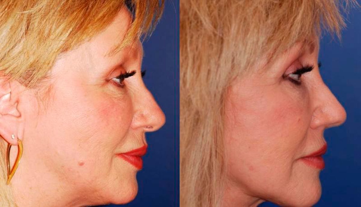 Facelift Before & After Gallery - Patient 406061 - Image 5