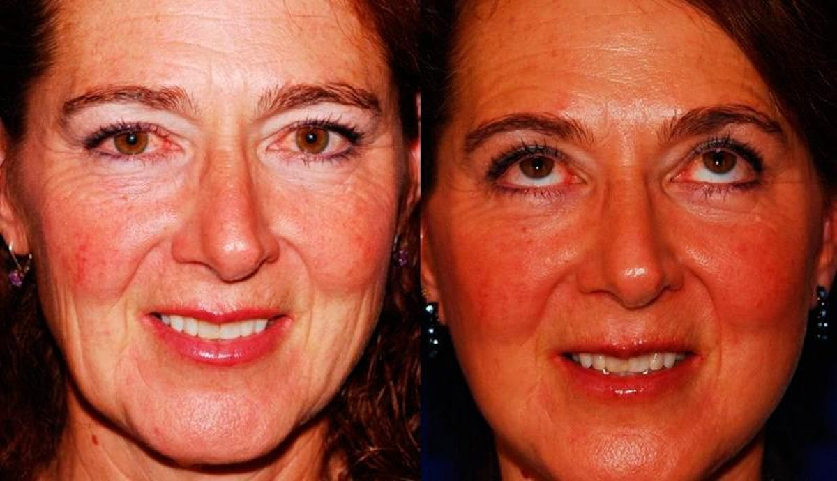 Facelift Before & After Gallery - Patient 171448 - Image 1