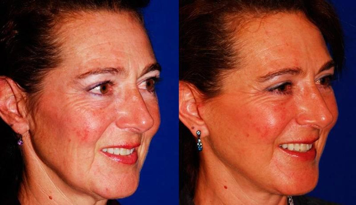 Facelift Before & After Gallery - Patient 171448 - Image 2