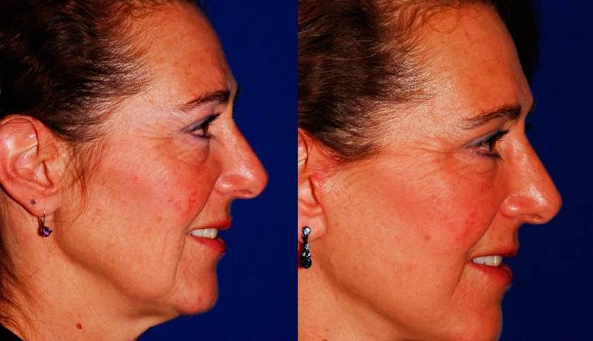 Facelift Before & After Gallery - Patient 171448 - Image 3