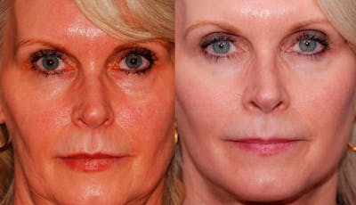 Facelift Before & After Gallery - Patient 179056 - Image 1