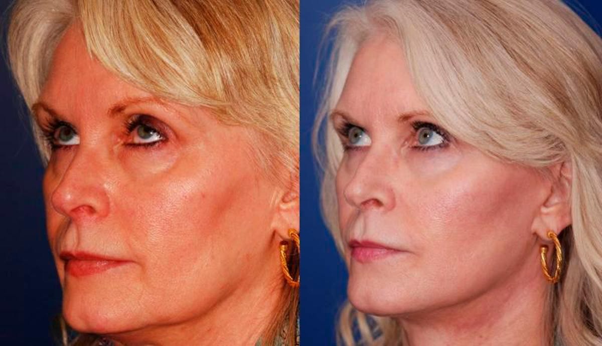 Facelift Before & After Gallery - Patient 179056 - Image 2