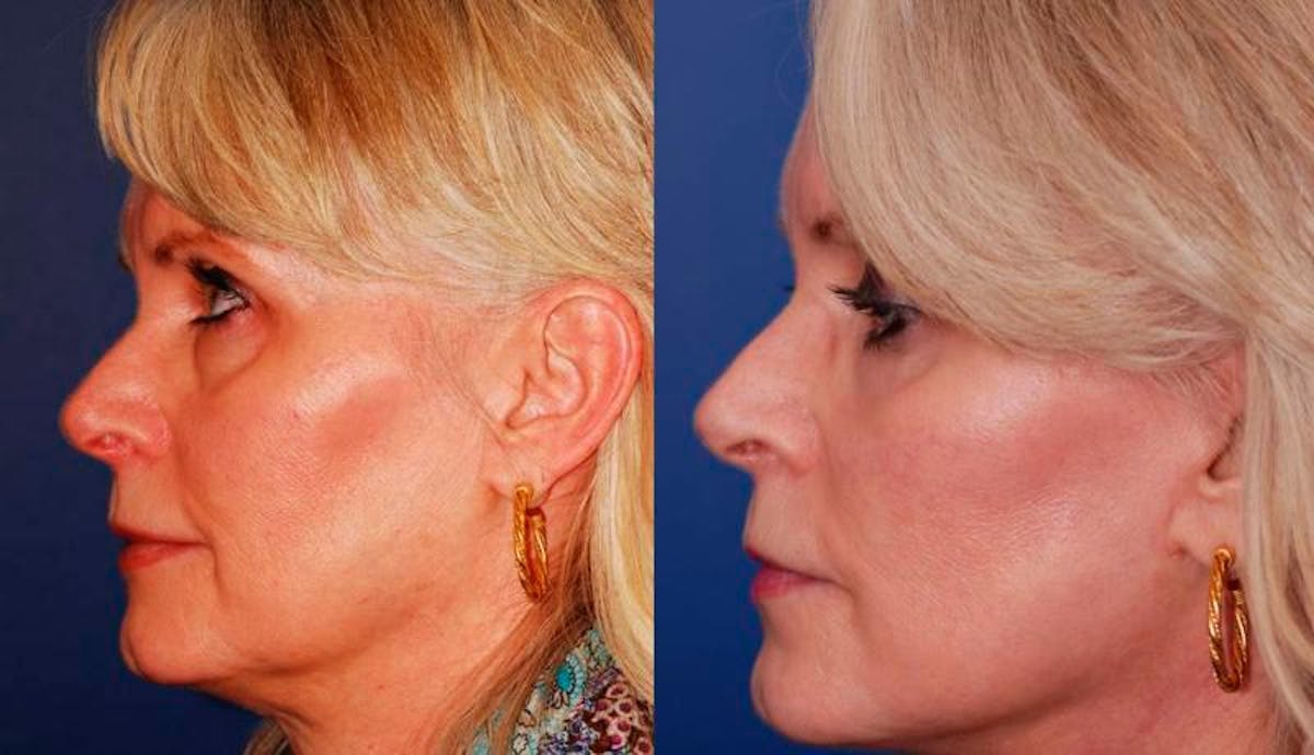 Facelift Before & After Gallery - Patient 179056 - Image 3