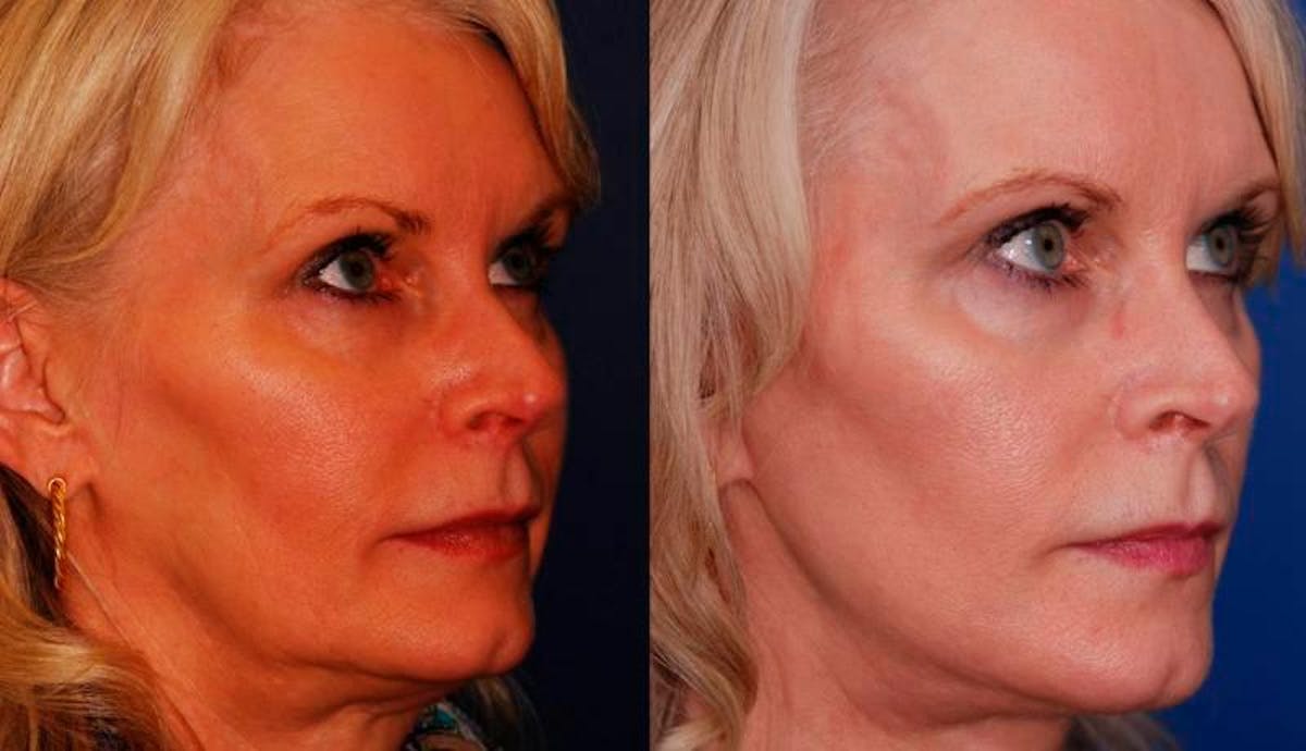 Facelift Before & After Gallery - Patient 179056 - Image 4