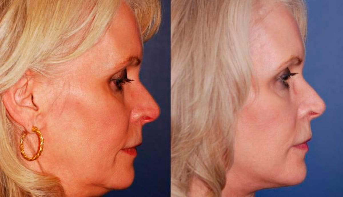 Facelift Before & After Gallery - Patient 179056 - Image 5